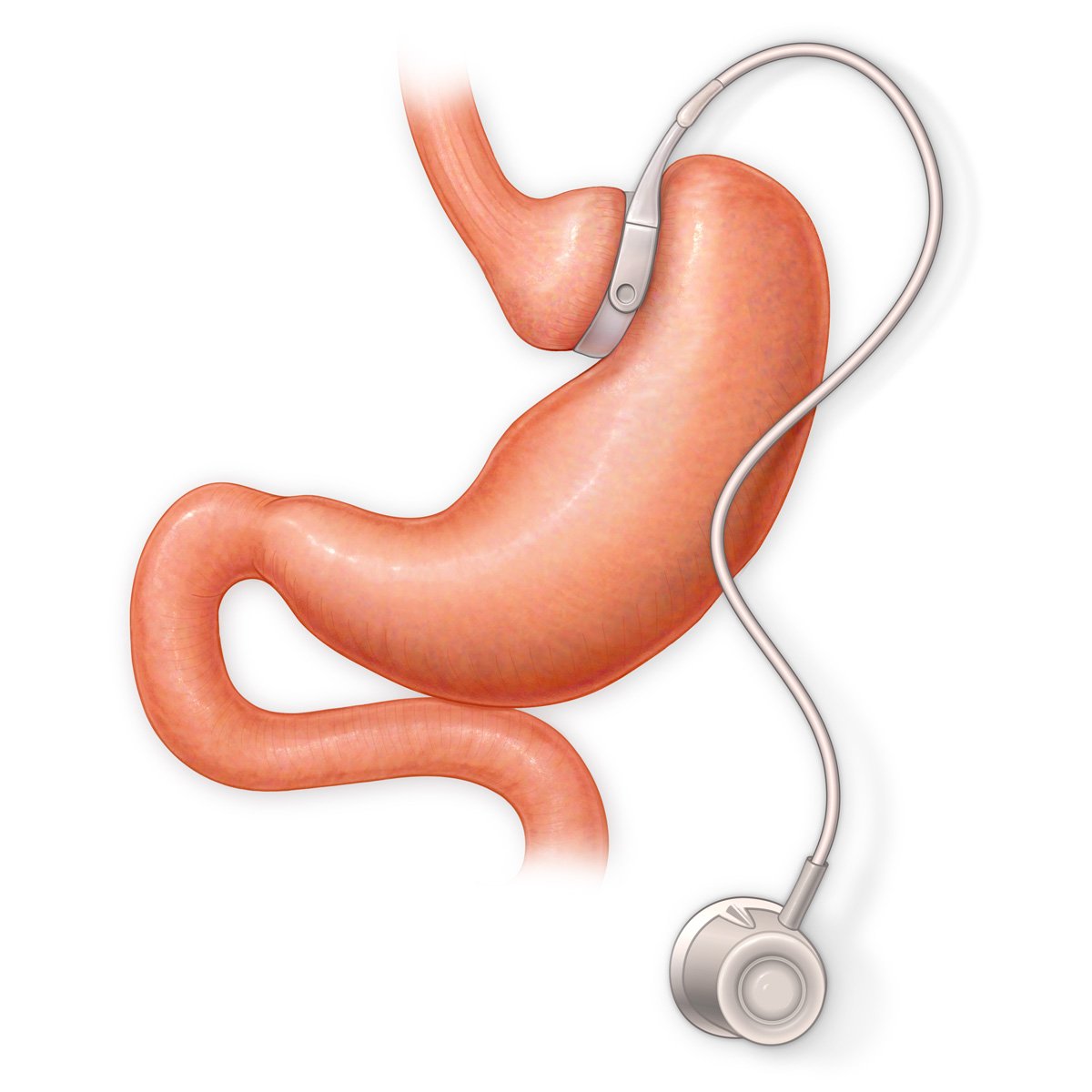 lap band melbourne – Complete Weight Loss Solution