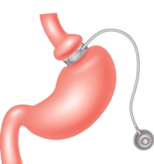 lap band surgery – Complete Weight Loss Solution