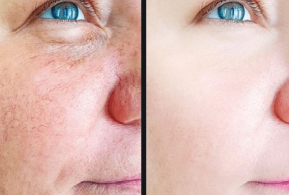 Distill Laser Clinic