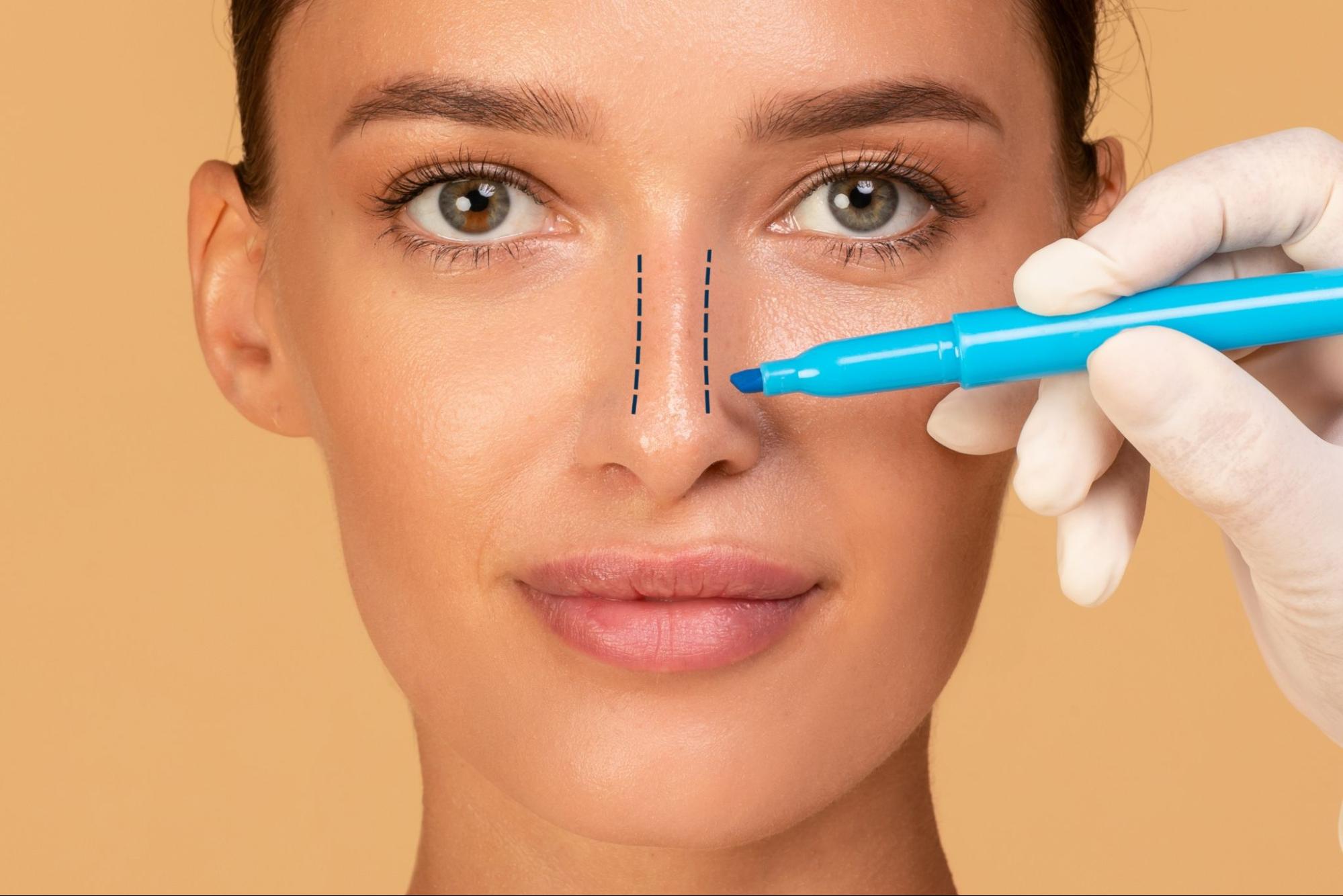 Rhinoplasty