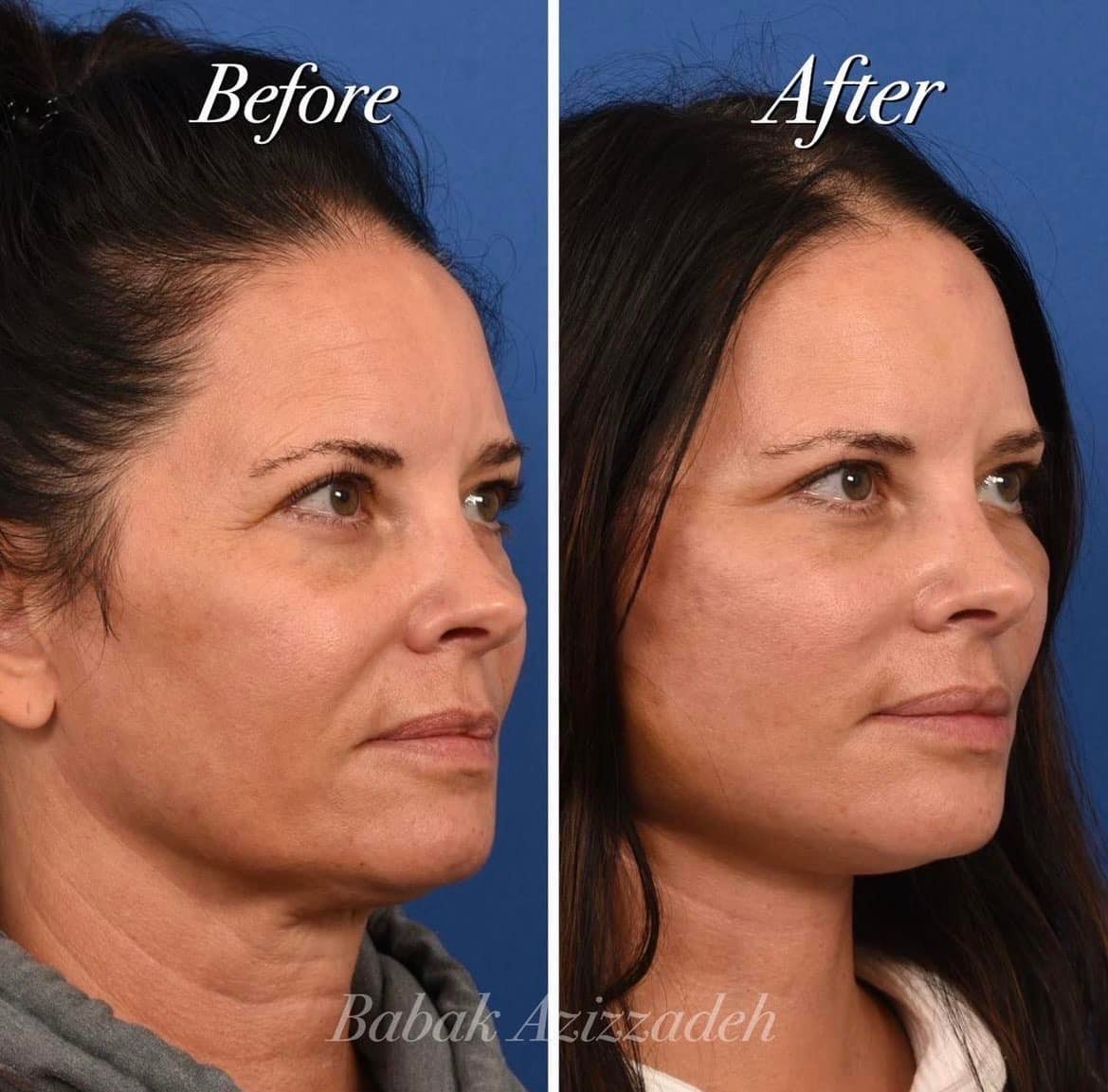 Center For Advanced Facial Plastic Surgery